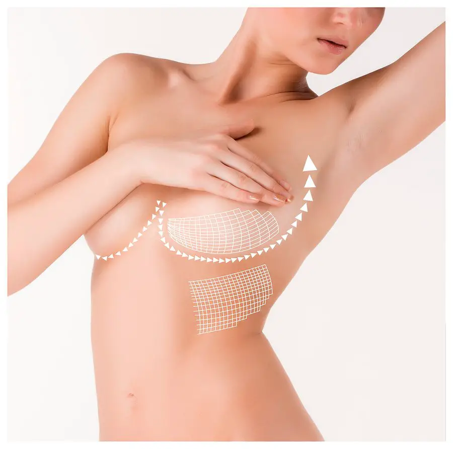 Breast enhancement - cosmetic surgery